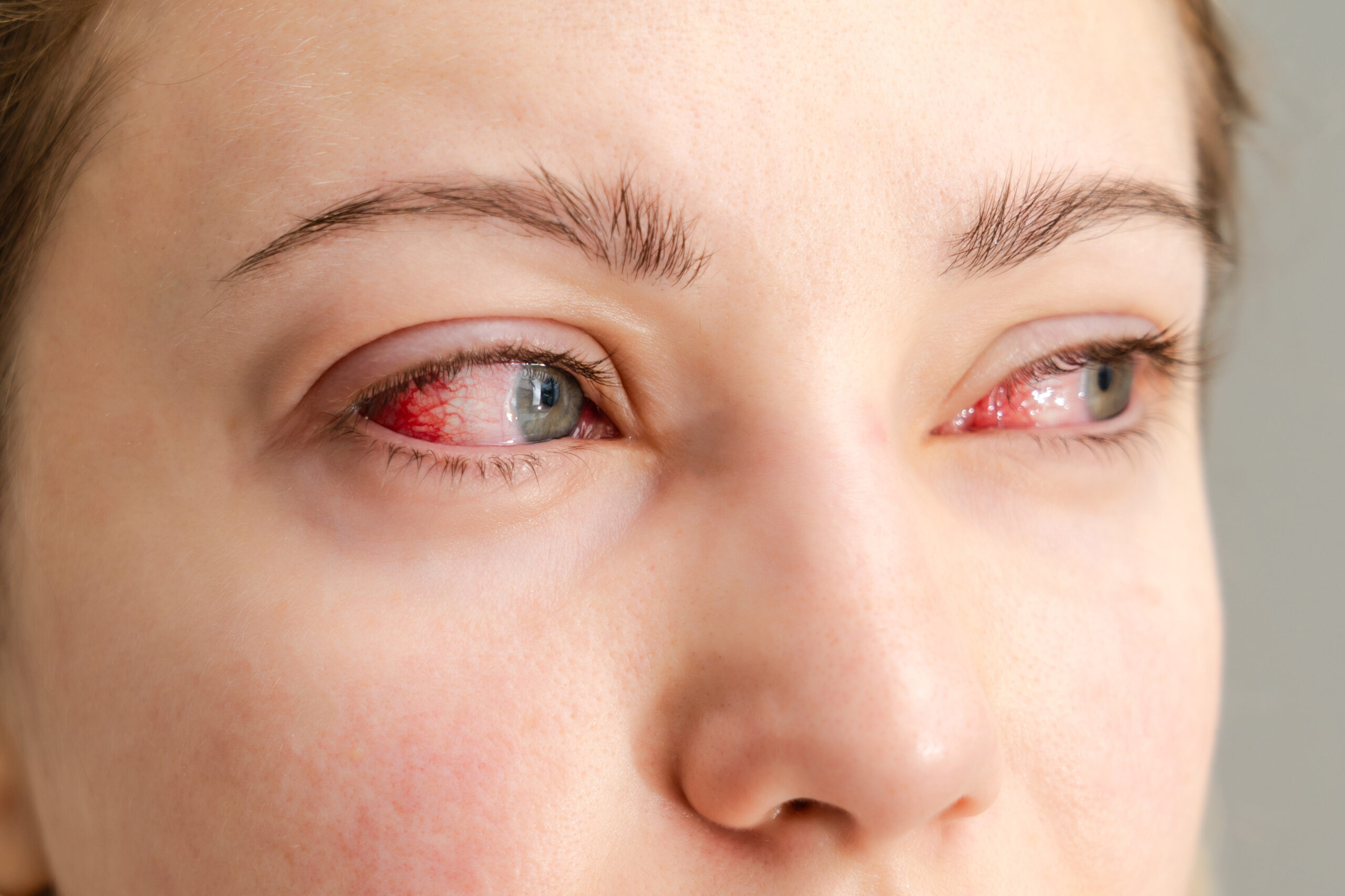 Eye Drops for Dry Eyes